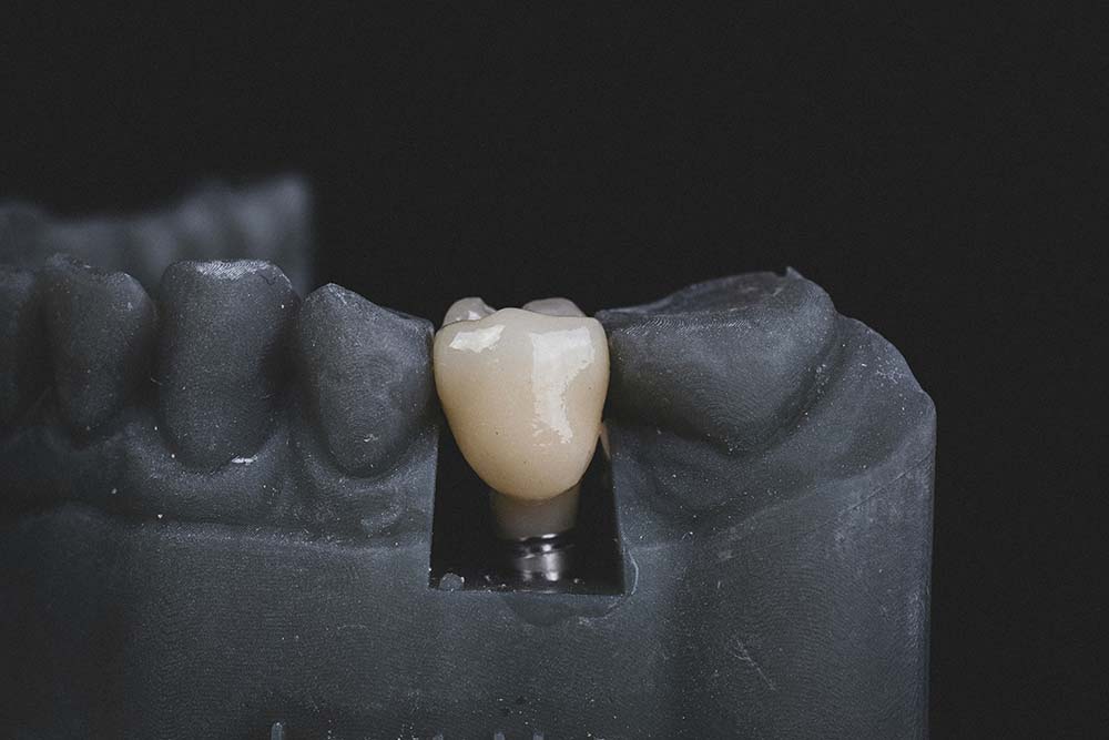 Cómo se hace un implante dental