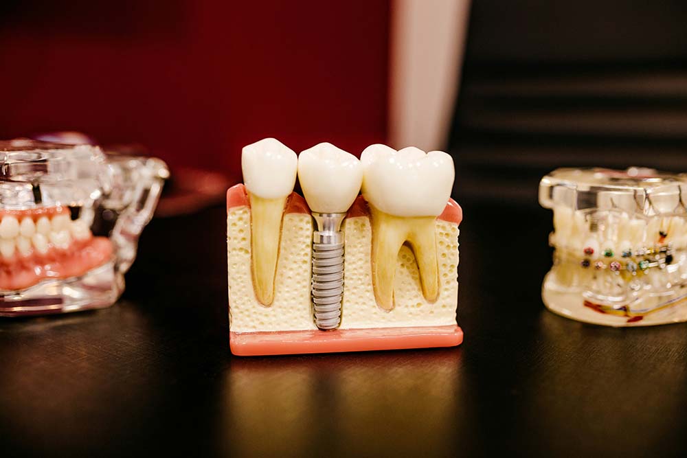 Dolor después de implante dental