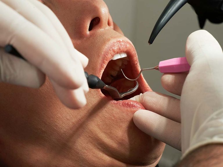 Qué es una endodoncia en una muela