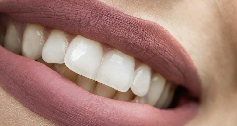 Cuánto cuesta un blanqueamiento dental