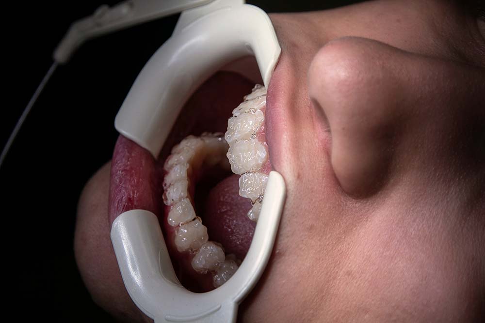 remedios para dientes que se mueven