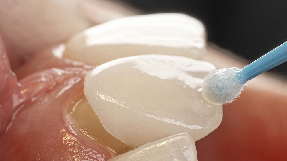 qué son las carillas