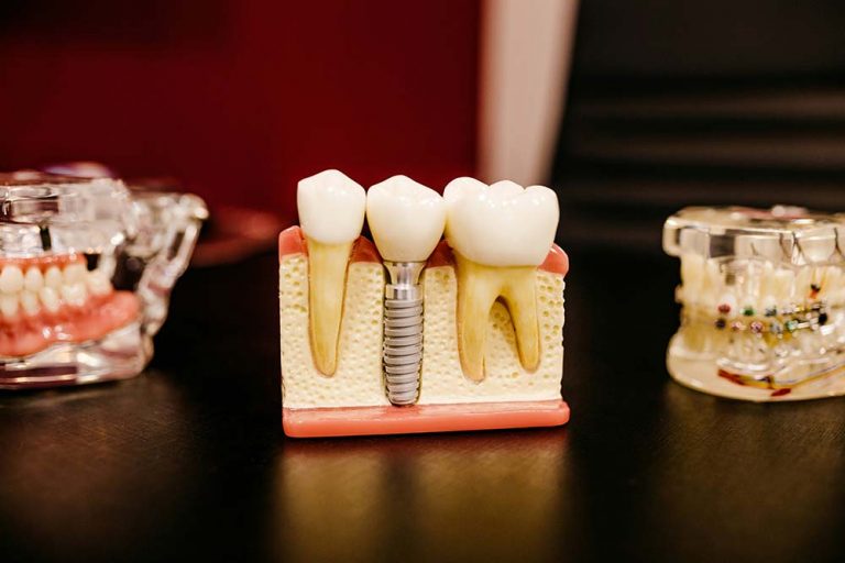 Dolor después de implante dental