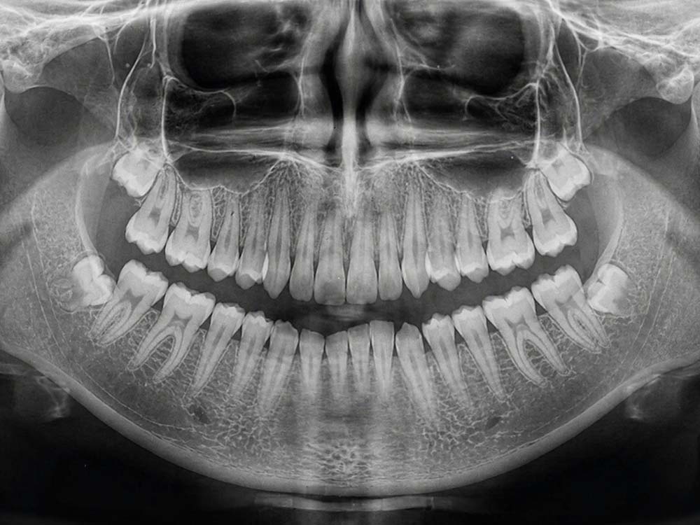 Radiografía dental