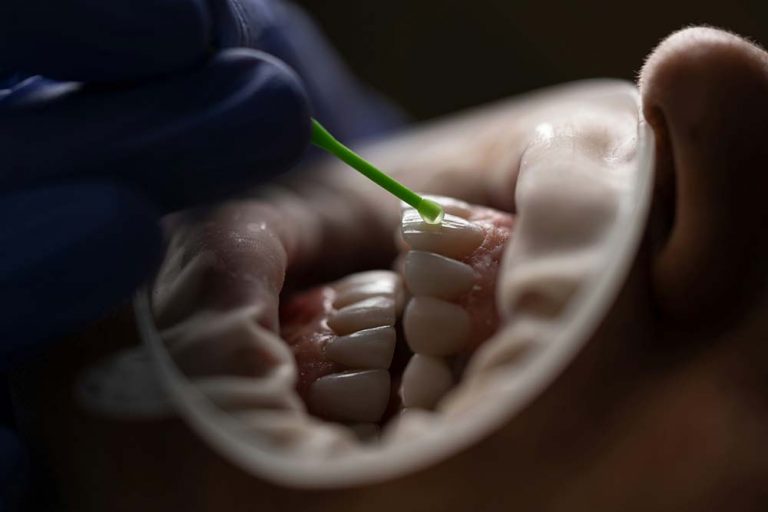 Limpieza dental