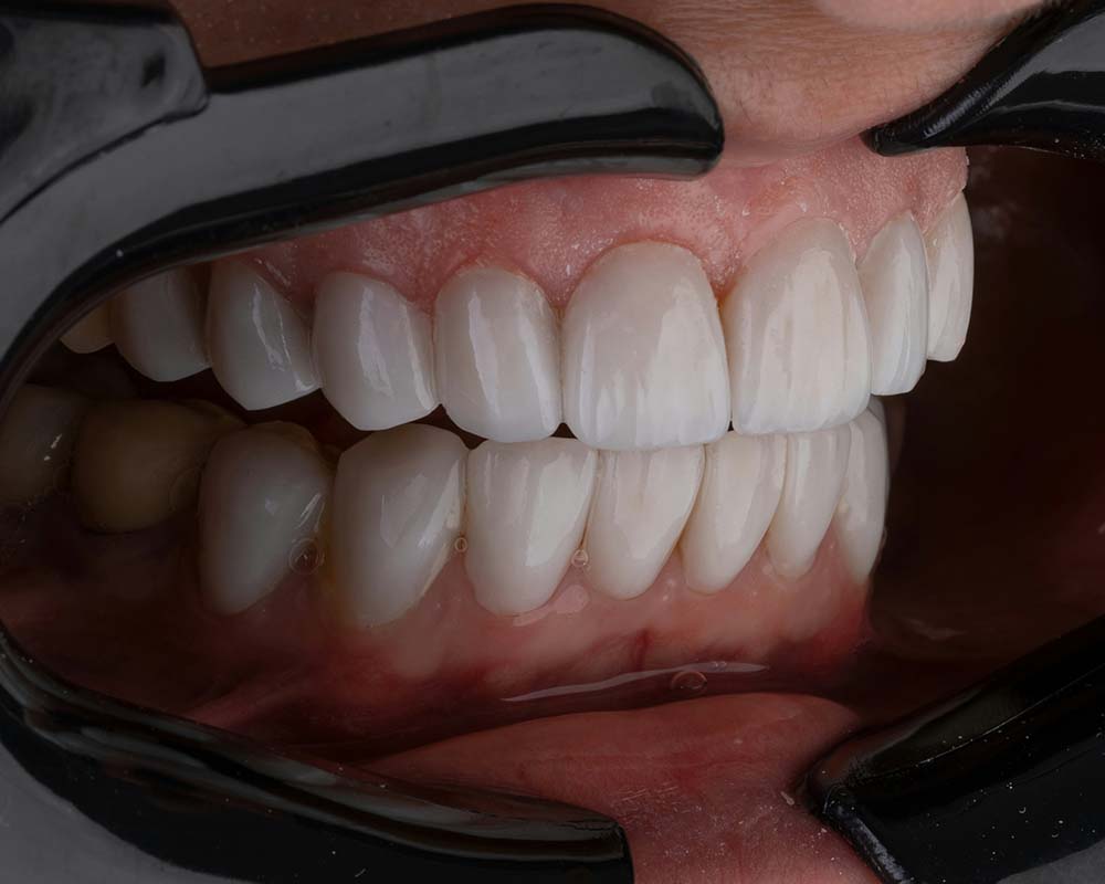 dientes separados