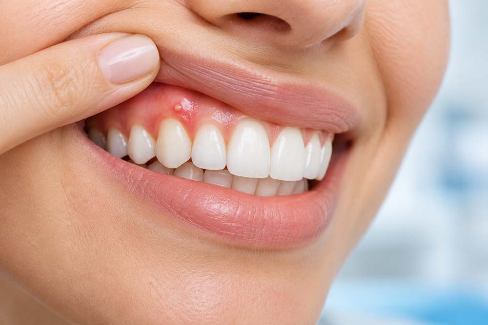 fistula dental foto